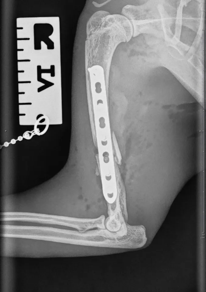 Humerus ML post OP 22 05 25