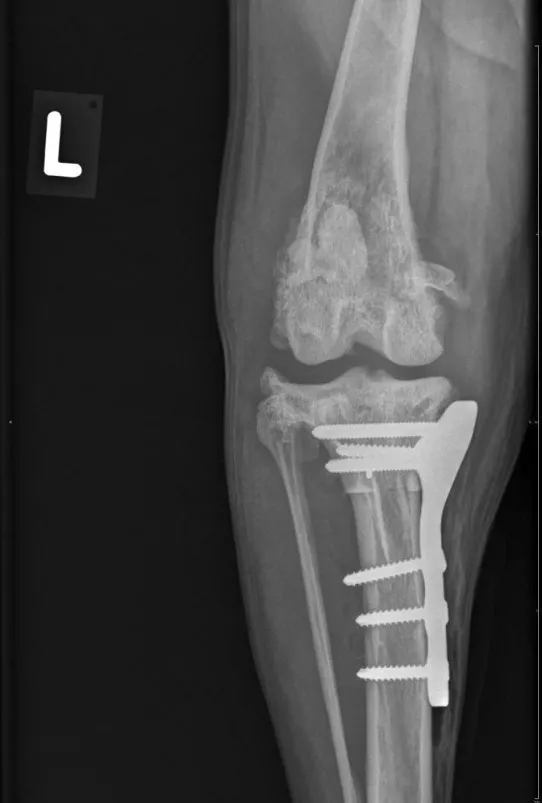 TPLO Edna
